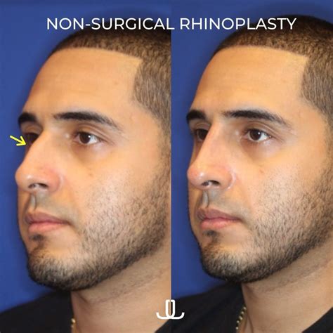 Can I Get A Nose Job Without Surgery? | Ask Dr. Levine | Dr. Jennifer ...