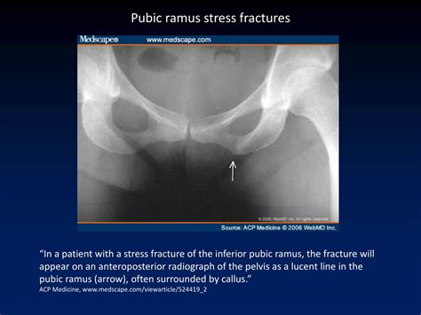 PPT - Pubic Ramus Stress Fractures: Diagnosis and Recovery PowerPoint Presentation - ID:9175608