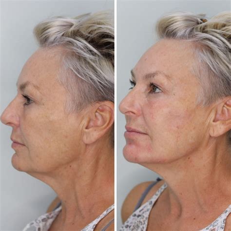 Non Surgical Face Lift Houston at Dorothy Hood blog