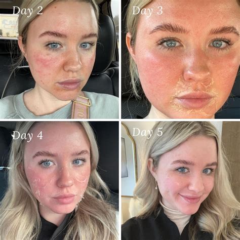 How Deep Does A Chemical Peel Go at Penny Troche blog