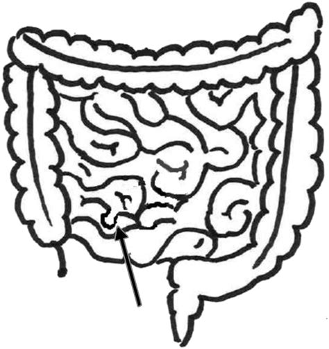 Meckel’s Diverticulum Imaging | Journal of Nuclear Medicine Technology
