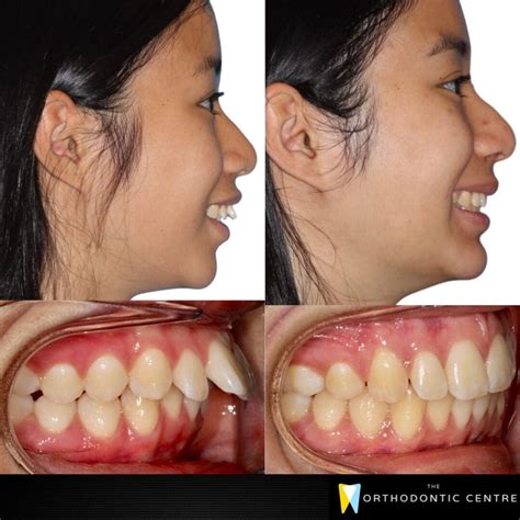Invisalign Before And After Buck Teeth