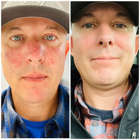 Flushed Face On Accutane at Sarah Bugarin blog