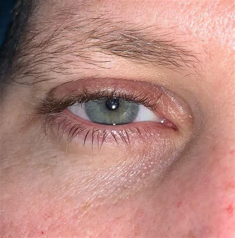 Rash along upper lash line - anyone know what this is? It’s red, raised, scaley and very itchy ...