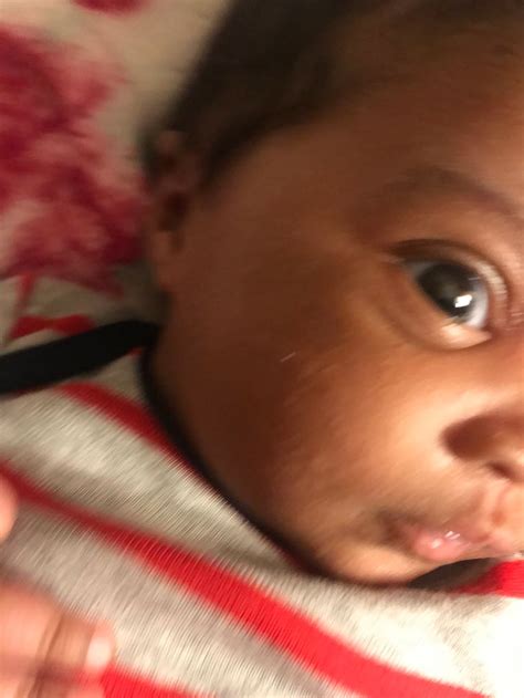 Heat Rash On Black Babies