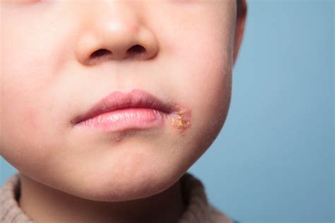 Fiebre en la boca: causas, duración y tratamiento | A Que Hora Juega Boca