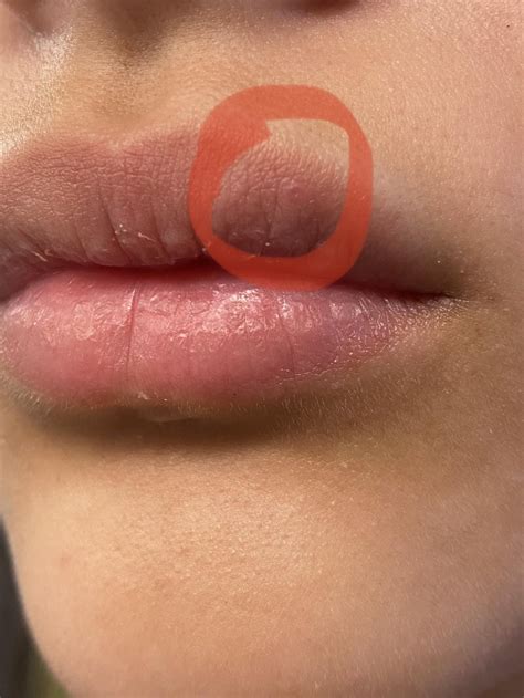 tiny bump on my lip, is it a cold sore : r/medical_advice