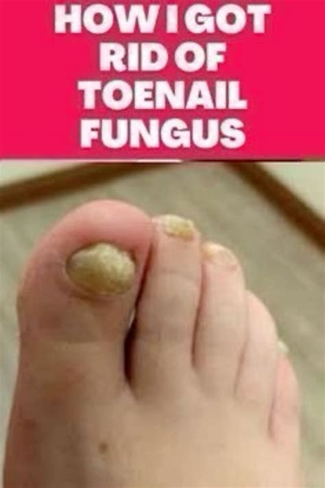 Kill toenail fungus with one simple trick – Artofit