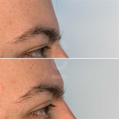 Prominent Brow Bone