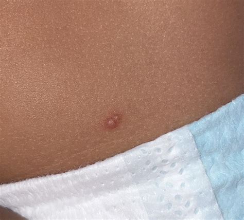 Black Ants Bites Different Kinds Of Black Ants | Western Exterminator