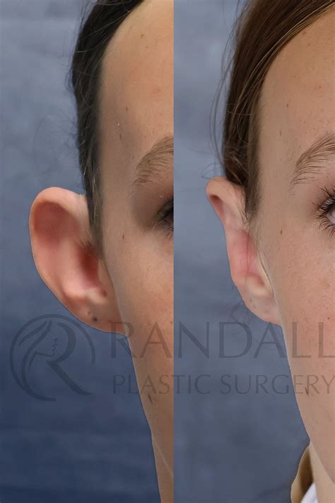 Otoplasty- Ear Pinning Surgery - Dr. Randall in Morristown, NJ