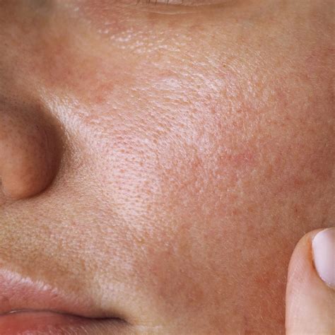 Close Pores On Face