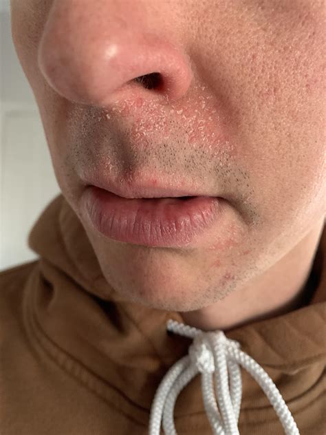 Flaky, dry rash around mouth? : r/DiagnoseMe