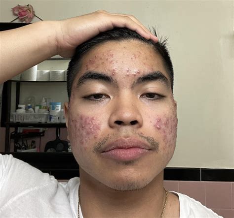 What 40 days of accutane has done to the worst acne ever : r/Accutane