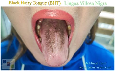 Black Hairy Tongue (BHT) Definition, Causes, Treatment