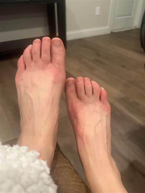 Burning feeling in feet and hands with alcohol : r/lupus