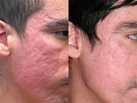 Erbium YAG Laser Tampa - Skin Resurfacing | Arviv Medical Aesthetics