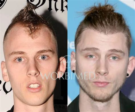 (MGK) Machine Gun Kelly Hair Transplant