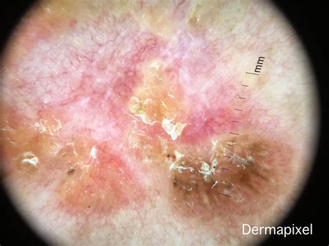 Dermapixel: La dermatoscopia de un Bowen