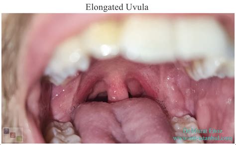 Your "Uvula" Can Tell You a Lot About Whether You Have Snoring and ...