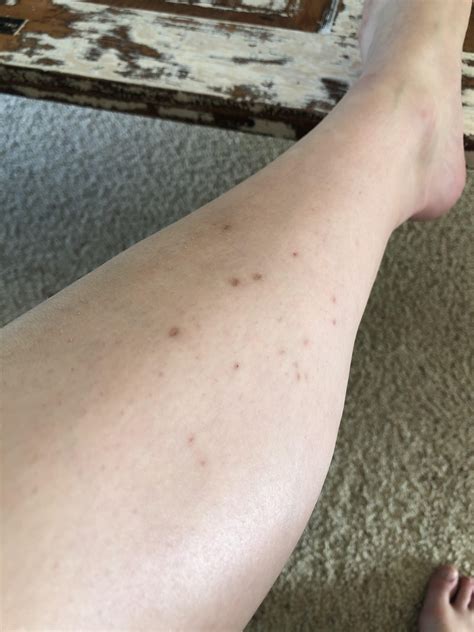 Removing Ingrown Leg Hair at Barry Atchison blog