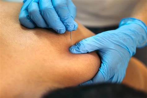 Dry Needling in Louisville | Focus Physical Therapy