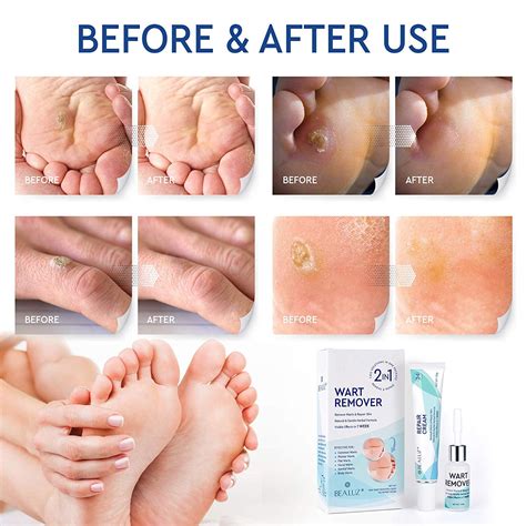 Stages Of Plantar Wart Removal Using Salicylic Acid : Types Of Warts ...