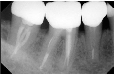 Zirconia Crown X Ray at Joi Williams blog