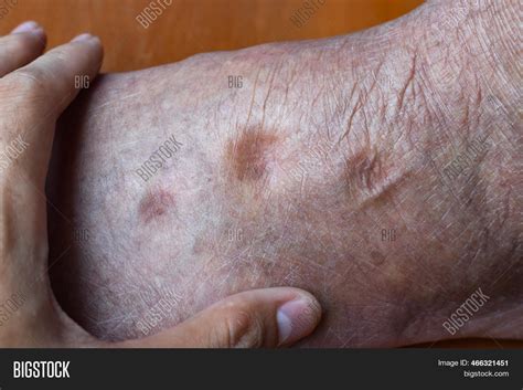 Pitting Edema Lower Image & Photo (Free Trial) | Bigstock