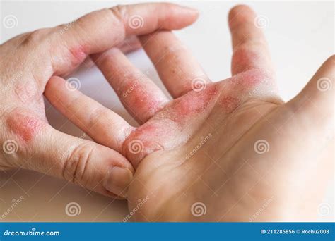 How To Heal Cracked Eczema Hands at Alice Hager blog