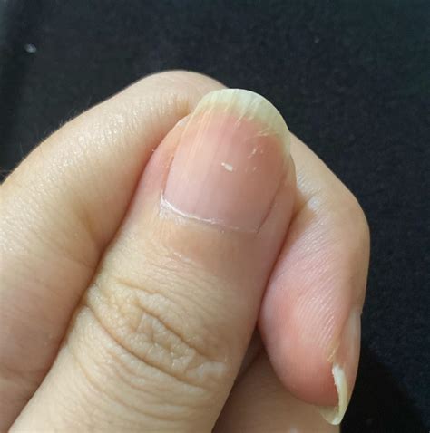 Zinc Deficiency Symptoms Nails ⚠Nail Deficiency Signs: 1. Medium Or