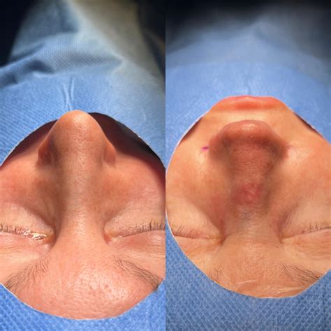 【Todo sobre la Fibrosis en Rinoplastia: Guía Completa 2025】