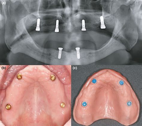 Implant Supported Dentures Maxillary