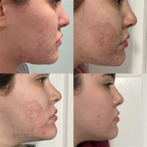 [Acne] 1 week progression of TCA Peel : r/SkincareAddiction