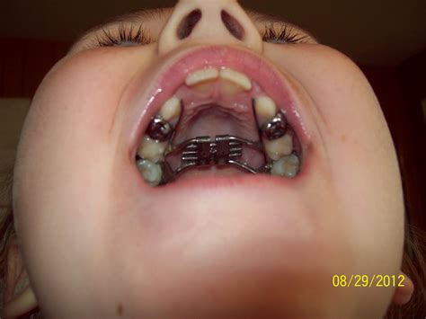 What Are Spacers For Missing Teeth at Virginia Olsen blog