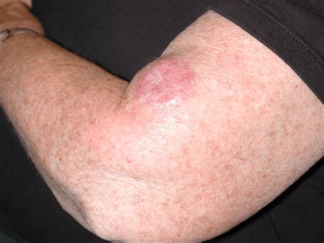 Lump On Arm Just Above Wrist at Jeremy Burris blog