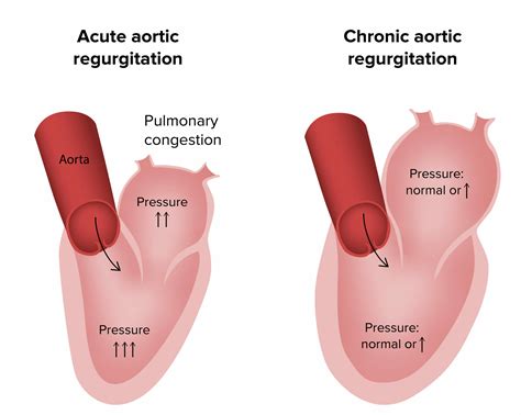 Regurgitação Aórtica | Concise Medical Knowledge