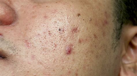 skin problems. problem of inflamed acne on the face. Inflamed acne consists of swelling, redness ...