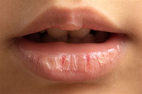5 Essential Oils for Chapped Lips (Dry and Split Lips) - Naturally Daily