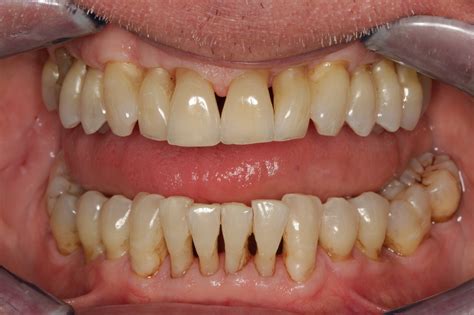 Understanding Gum Recession: Causes, Symptoms, Prevention, and Treatment — Nova Smiles