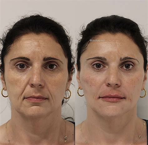 Face Rejuvenation Without Surgery