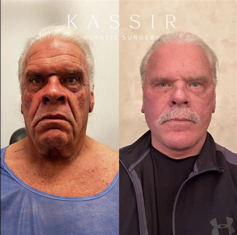 NYC Male Facelifts: Recovery and Transformation — Kassir Plastic Surgery in NY and NJ