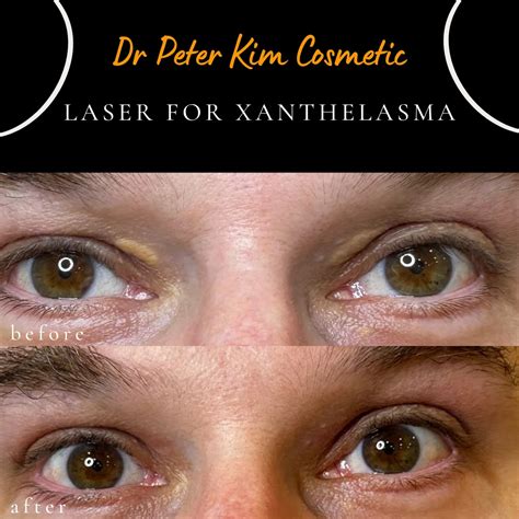 Xanthomas Removal A Xanthelasma Is A Yellow Bump On Or Near Your