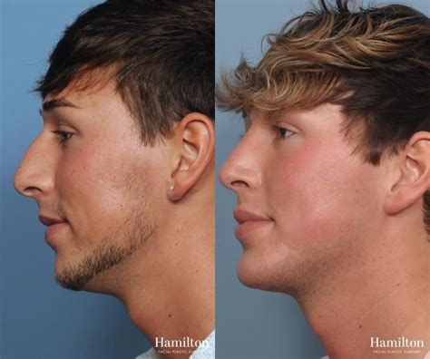 Chin Augmentation Before & After Gallery