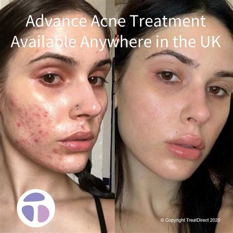 Accutane Before and After: Transformative Results and Essential Tips ...