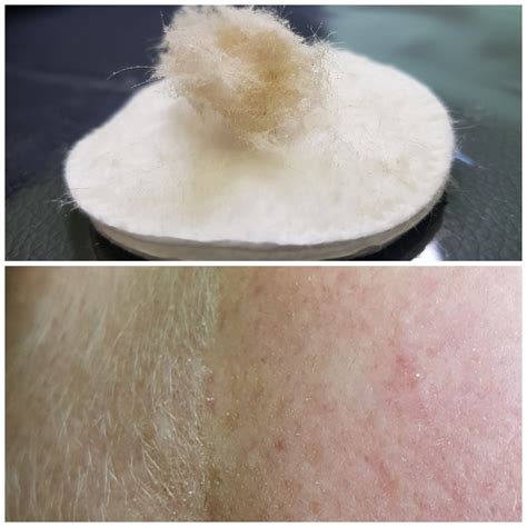 Why Does My Skin Feel Rough After Dermaplaning at James Frary blog