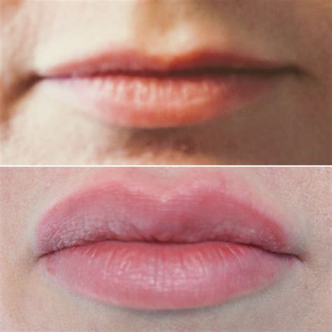 Juvederm Lips Before And After Half Syringe at Jeremy Burris blog