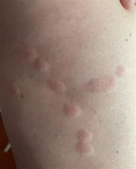 Bed Bugs Rash Treatment