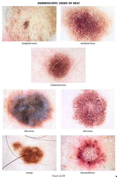 Dysplastic Nevus Vs Melanoma