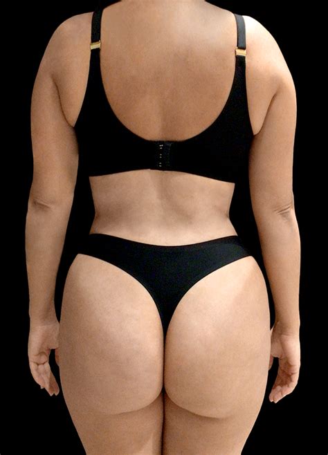 ¿Qué es BBL? - Ideal Plastic Surgery